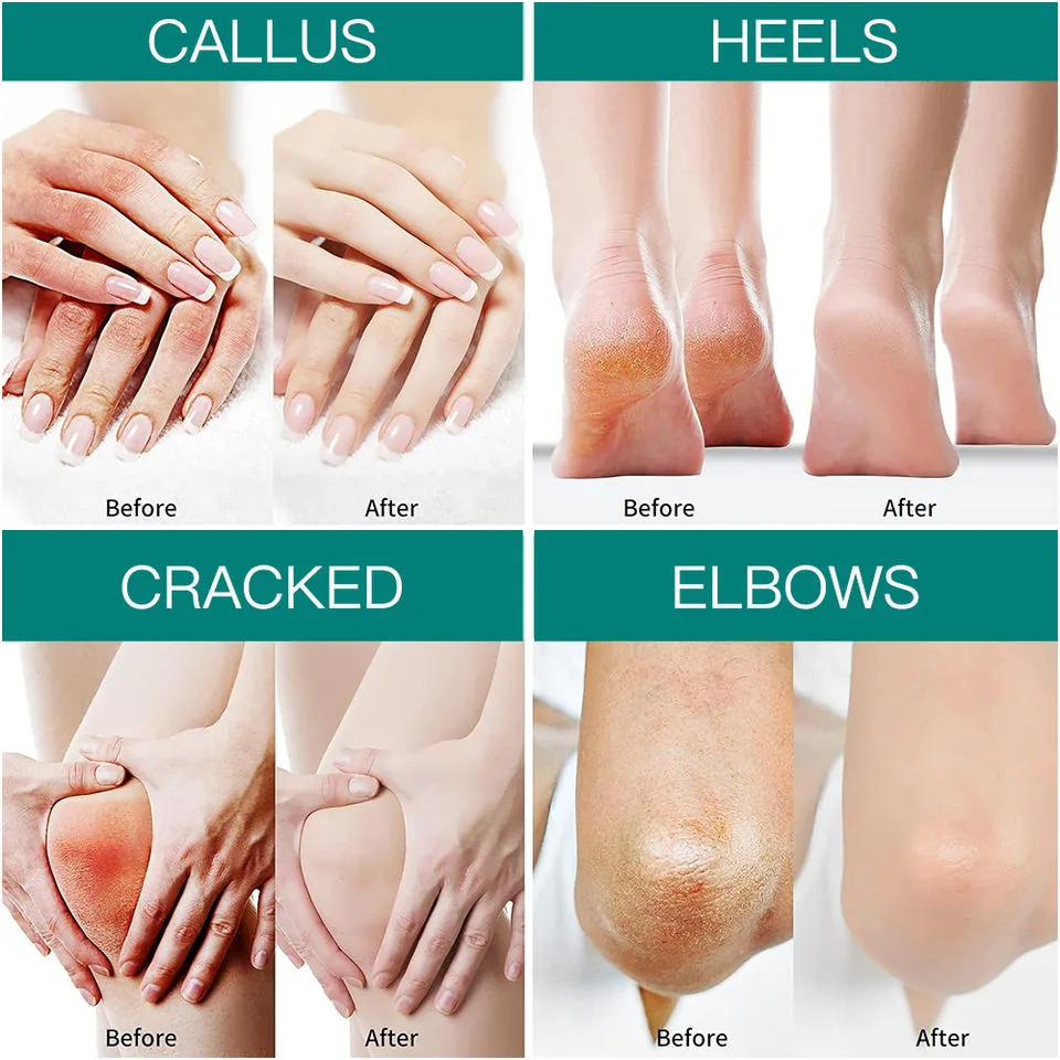 Urea Foot Cream 4